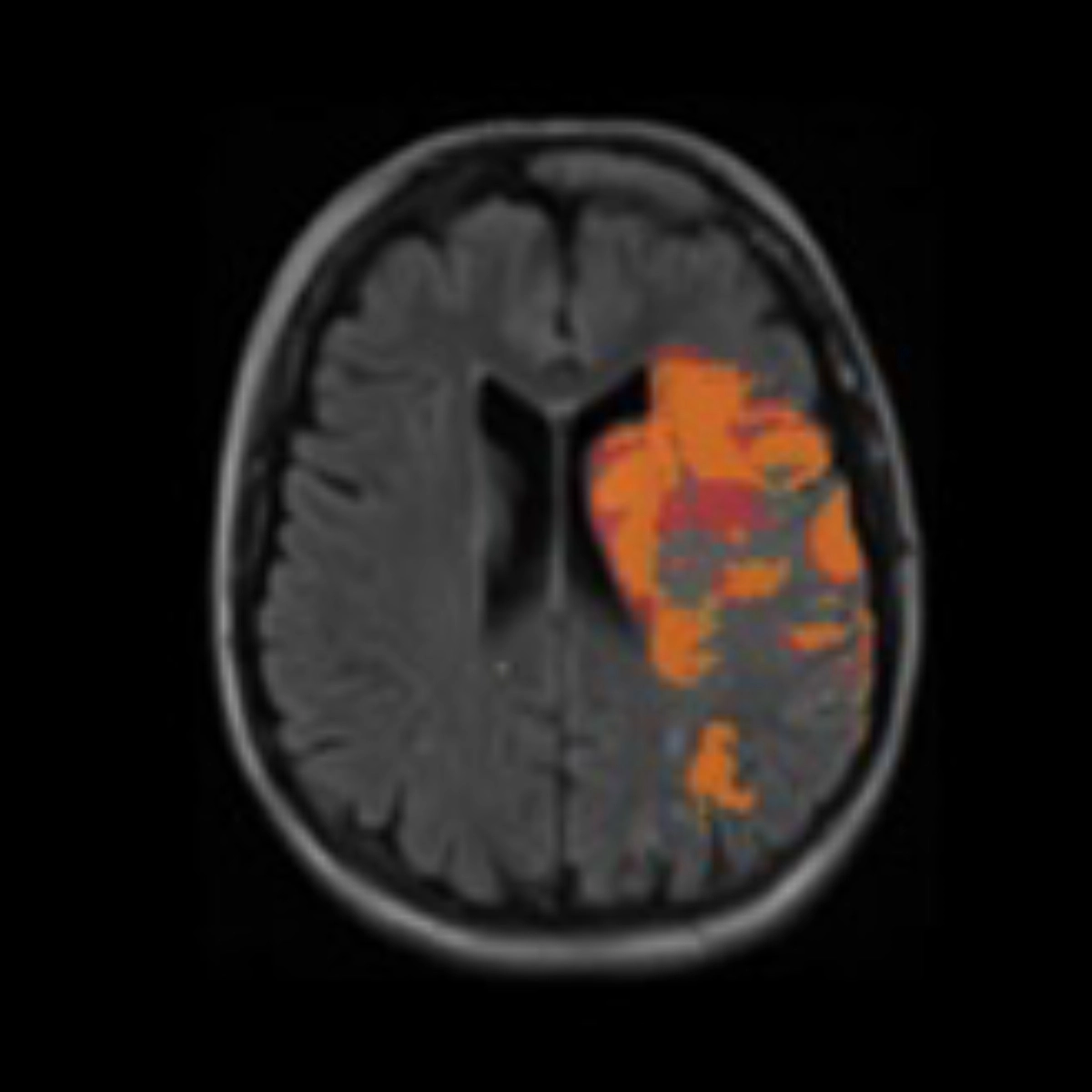 Edema