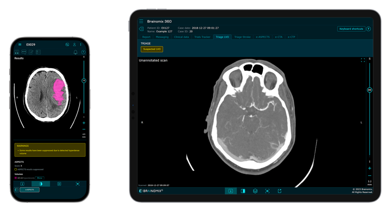 E ASPECTS (CE Marked) + Triage LVO (Iphone + Ipad Pro)