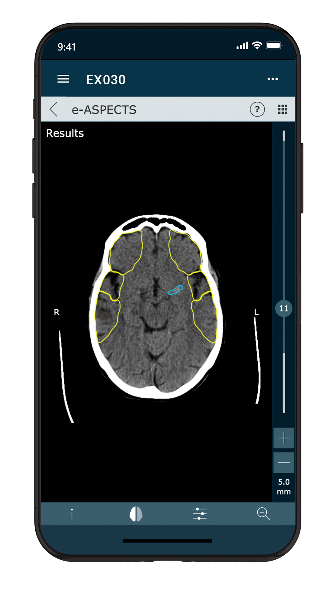 e-ASPECTS V 10.0 Mobile (LVO)