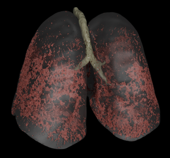 Fibrosis (Black BG)