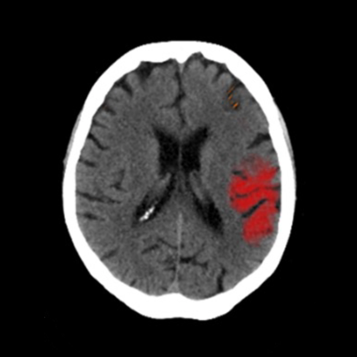 Ischemic