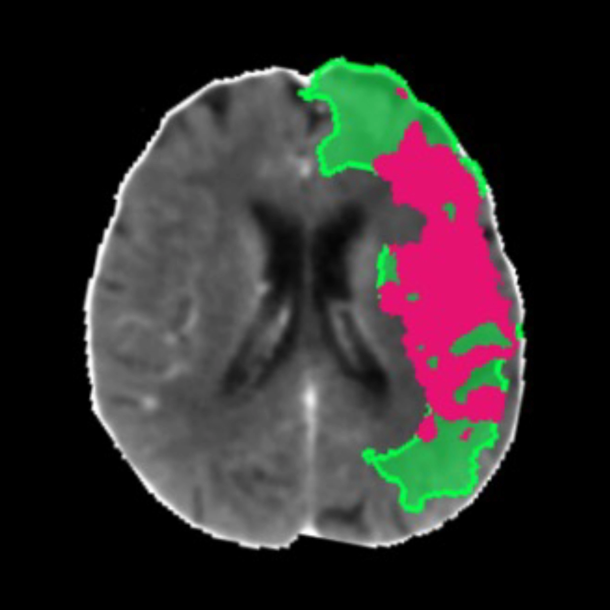 Perfusion